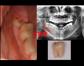 �e�m�炸�F���o���ʐ^�ƃp�m���}Xray�ʐ^�i2�����j